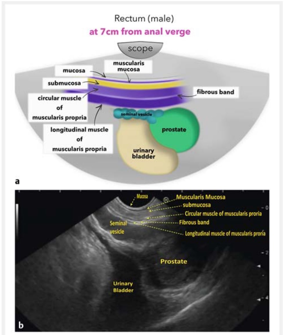GIscope_updates's tweet photo. EUS of the rectum &amp; anal canal

✅ https://t.co/yt8LmaEnVv https://t.co/3EENGR31j9
