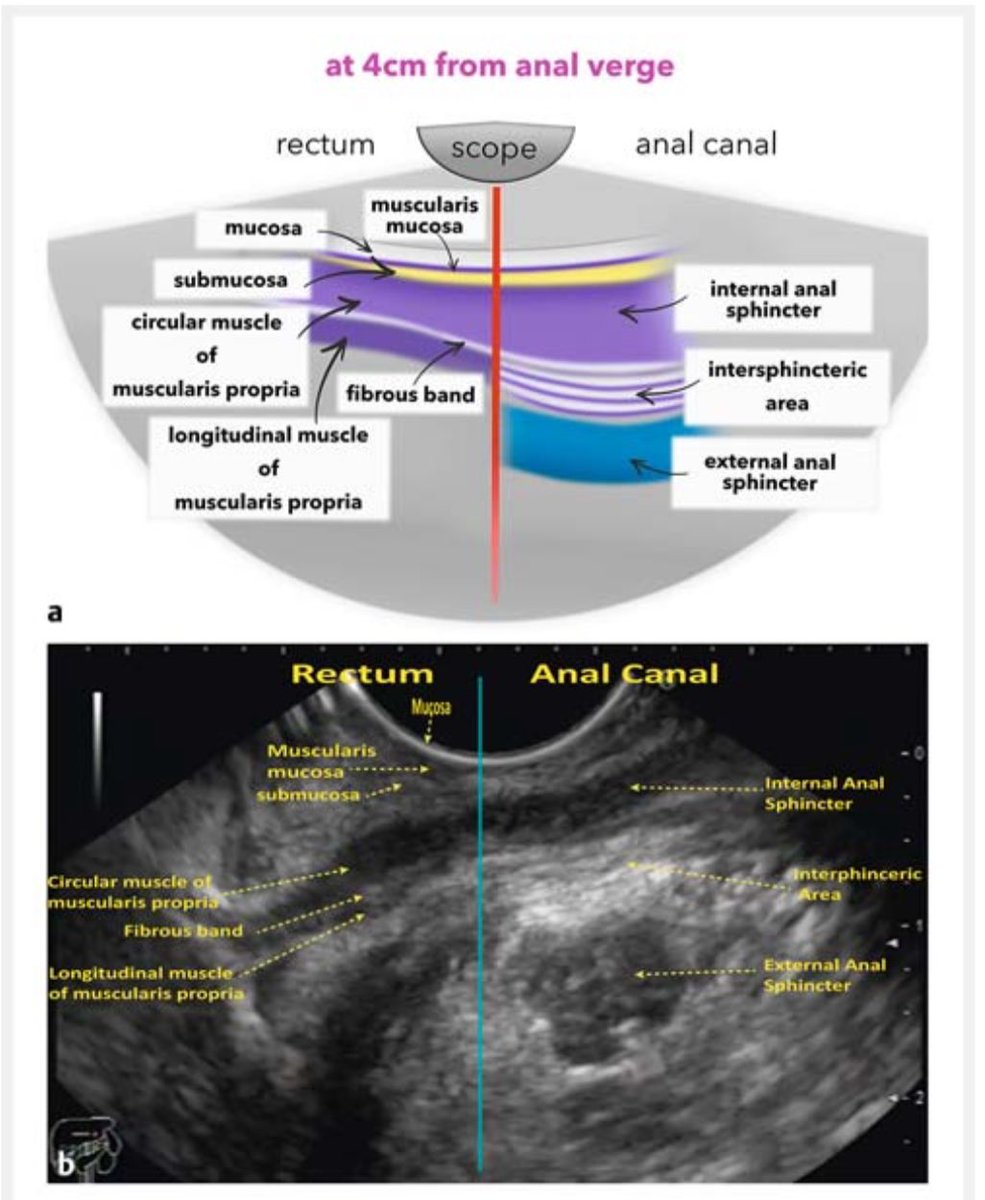 GIscope_updates's tweet photo. EUS of the rectum &amp; anal canal

✅ https://t.co/yt8LmaEnVv https://t.co/3EENGR31j9