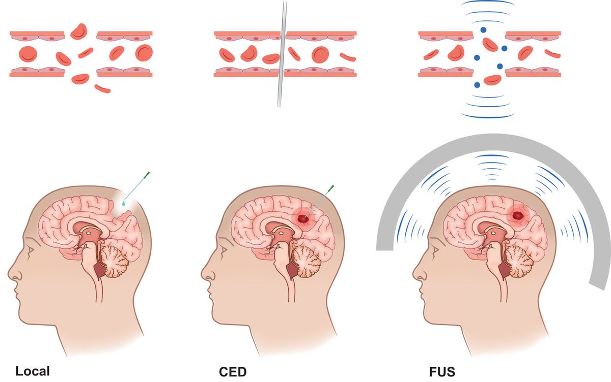 SNM_MI's tweet photo. The Journal of Nuclear Medicine outlines the future of #theranostics in #neurooncology: https://t.co/jPhcQfaVyY

#NuclearMedicine @JournalofNucMed https://t.co/74TtOHH4Li