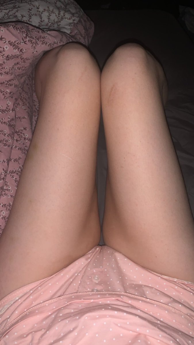 chlorexic's tweet photo. TW-edtwt, bodych3ck

5 days ago vs now is there a difference or am i tripping PS ignore my thigh fat https://t.co/AJb5e0rBew