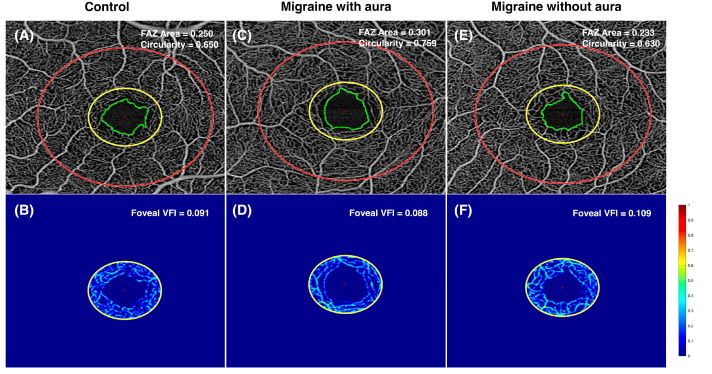 Via <a href="/HeadacheJournal/">Headache Journal</a>: Distinct retinal vascular signatures could become biomarkers for migraine—and may help clinicians understand other types of headache disorders, too: bit.ly/42NK6Of

#NeuroTwitter <a href="/kmpodraza/">Katherine Podraza, MD PhD</a> <a href="/nitinb2/">Nitin Bangera, PhD</a> <a href="/andycharlesucla/">ANDREW Charles</a> @AndrewGoLeeMD1 <a href="/kathleen_digre/">kathleen digre</a>