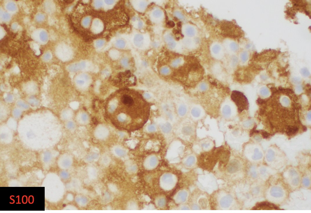 Beautiful touch preparations of a Rosai-Dorfman Case. 
#hemepath #PathTwitter #MedTwitter #cytopath