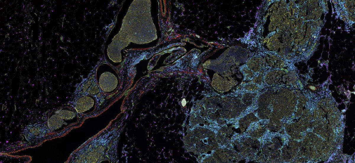 RareCyte's tweet photo. See how this one-step stain and scan workflow produced subcellular and same-section H&E imaging of a 15-plex breast adenocarcinoma. Explore the data,
https://t.co/ArTxKqcE0D
#spatialbiology #spatialimaging #breastcancer #rarecyte https://t.co/OQKXXdA7ve