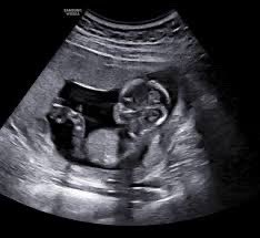 Draculapek's tweet image. After 2 years I’m having a boy🩵