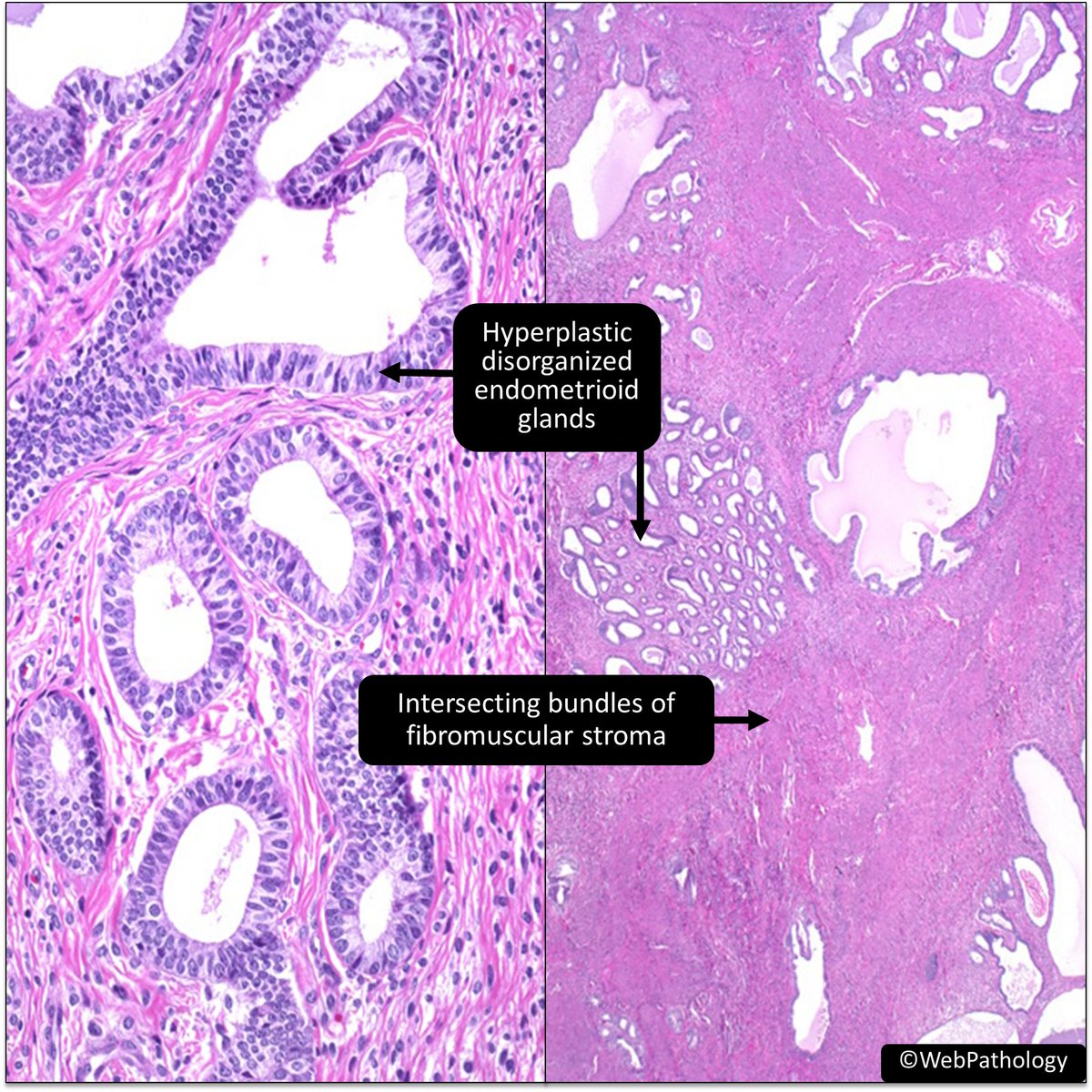 Uterus.
A) Adenomyosis
B) Atypical Polypoid Adenomyoma (APA)
C) Adenomatoid Tumor
D) Adenofibroma 
#GynPath #BSTPath #PathResidents #PathTwitter