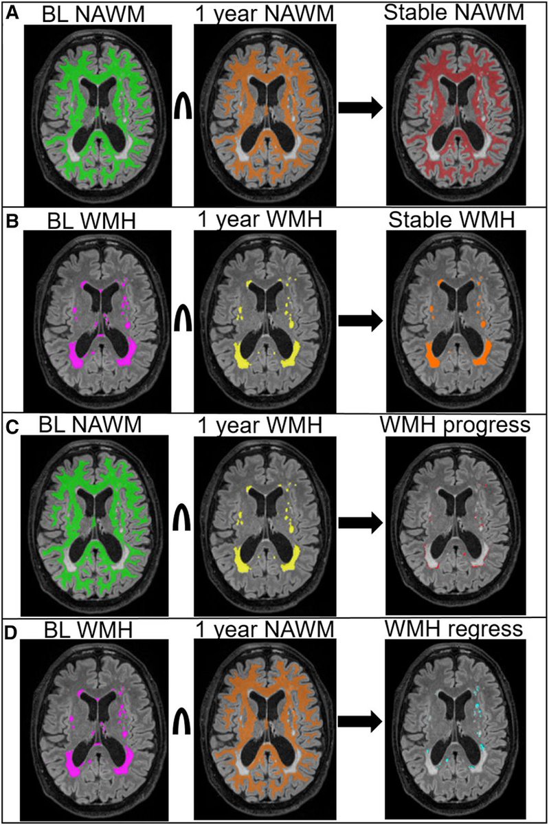 JAHA (@jaha_aha) on Twitter photo Quantitative MRI of white matter hyperintensity dynamics reveals better microstructure and different patterns of change in regressing white matter hyperintensities. #AHAJournals <a href="/SVDResearch/">SVDResearch</a> @AngelaJochems ahajrnls.org/3SFN6HY Quantitative MRI of white matter hyperintensity dynamics reveals better microstructure and different patterns of change in regressing white matter hyperintensities. #AHAJournals <a href="/SVDResearch/">SVDResearch</a> @AngelaJochems ahajrnls.org/3SFN6HY