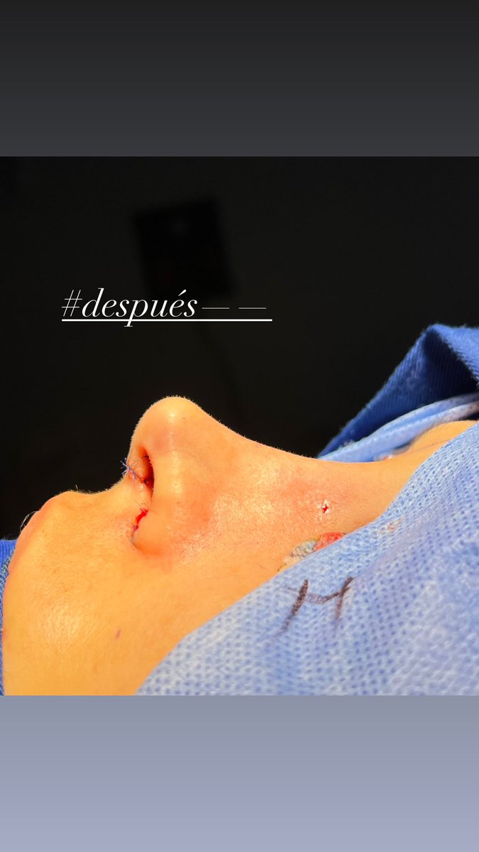 Lionarcp's tweet photo. Rinoplastia Hibrida https://t.co/f6tdjyXLML