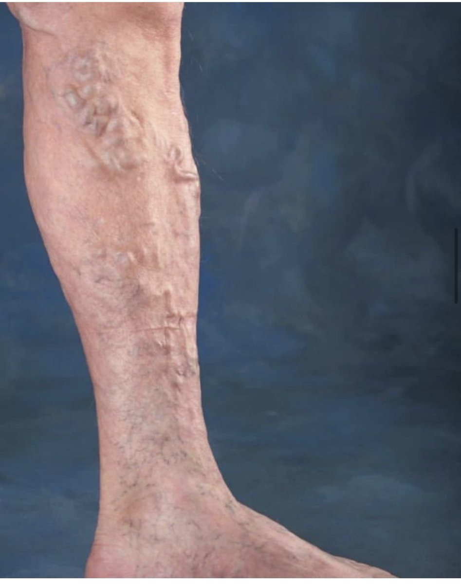 🚨 #MedicalMCQ Alert! 🩺

Patients present with pain and prominent veins. 

What's the #diagnosis?

a) Varicose veins
b) Deep vein thrombosis
c) Peripheral artery disease
d) Chronic venous insufficiency

#MedTwitter #VascularHealth 💉🩸