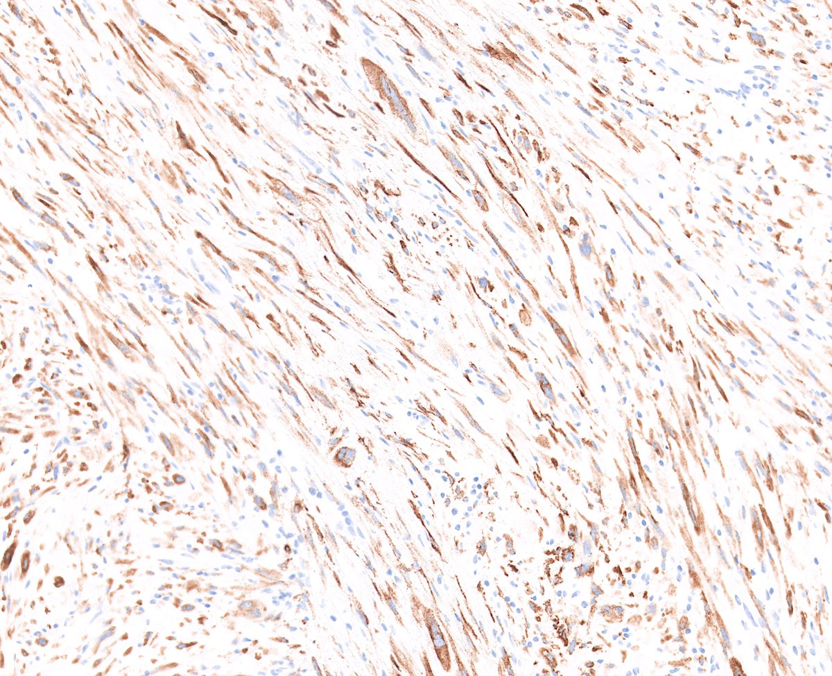 Look out - it's the myxoid, MUC4-positive variant of superficial CD34-positive fibroblastic tumor (PRDM10-rearranged soft tissue tumor) #BSTpath