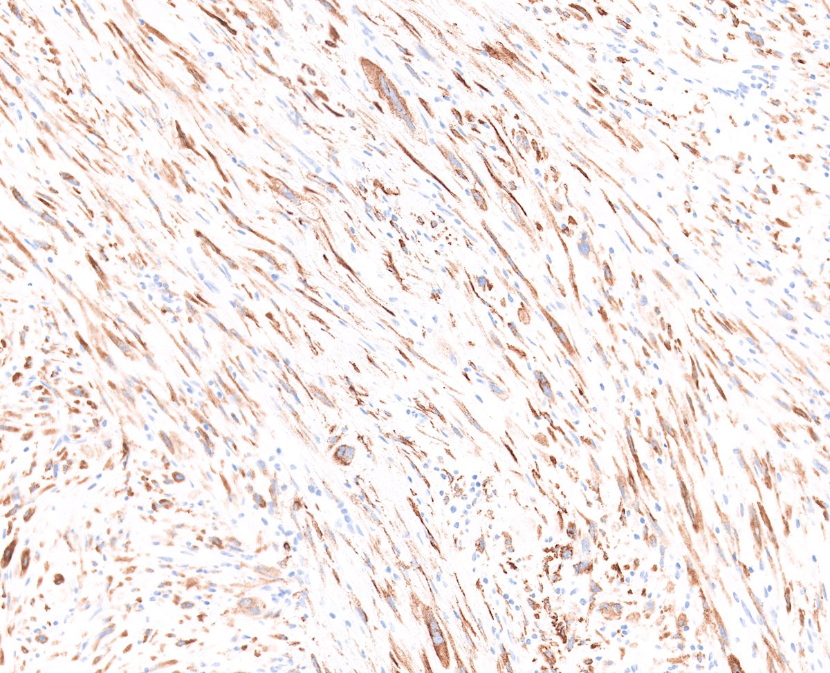 Look out - it's the myxoid, MUC4-positive variant of superficial CD34-positive fibroblastic tumor (PRDM10-rearranged soft tissue tumor) #BSTpath