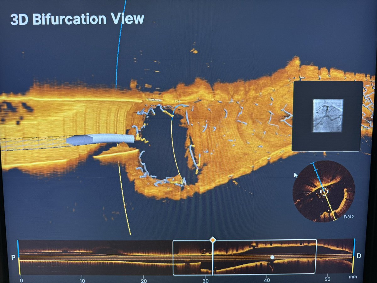 morrethound's tweet photo. Is really T stenting the best TAP? Angiography may often be misleading when you attempt to nail the ostium of LCX as your guesstimate on the ostium location may be totally wrong! However with OCT you can precisely correct the geographical miss!
@AbbottNews @BURZOTTA_F https://t.co/B8RGbQh0Jt