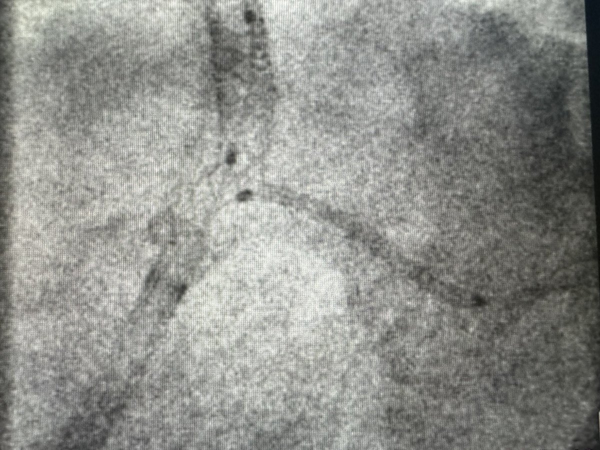 morrethound's tweet photo. Is really T stenting the best TAP? Angiography may often be misleading when you attempt to nail the ostium of LCX as your guesstimate on the ostium location may be totally wrong! However with OCT you can precisely correct the geographical miss!
@AbbottNews @BURZOTTA_F https://t.co/B8RGbQh0Jt