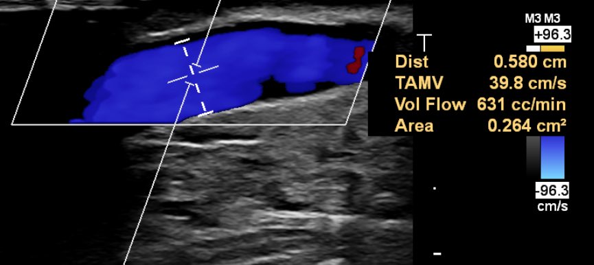 realmcoyph's tweet photo. Regions first cannulation of an 8 weeks old pAVF#ellipsys#medtronic#sonosite

Extensive ground work to reach this milestone. Lead by @ManarKhashram
@WaikatoVascular @jyndvthsn @tan_eddie https://t.co/VpjEFpWRIT