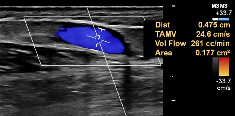 realmcoyph's tweet photo. Regions first cannulation of an 8 weeks old pAVF#ellipsys#medtronic#sonosite

Extensive ground work to reach this milestone. Lead by @ManarKhashram
@WaikatoVascular @jyndvthsn @tan_eddie https://t.co/VpjEFpWRIT