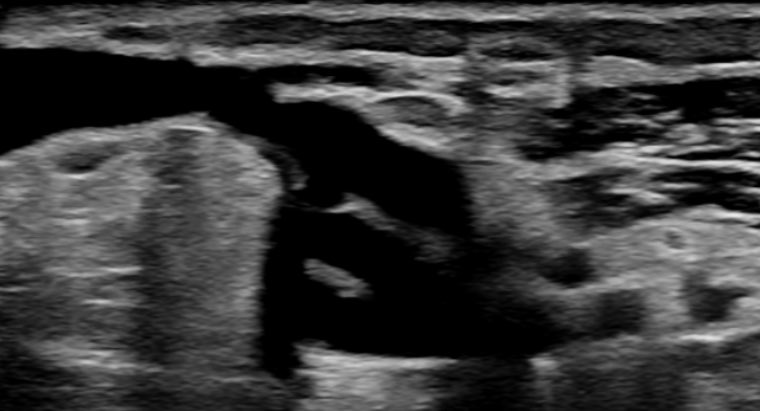 realmcoyph's tweet photo. Regions first cannulation of an 8 weeks old pAVF#ellipsys#medtronic#sonosite

Extensive ground work to reach this milestone. Lead by @ManarKhashram
@WaikatoVascular @jyndvthsn @tan_eddie https://t.co/VpjEFpWRIT