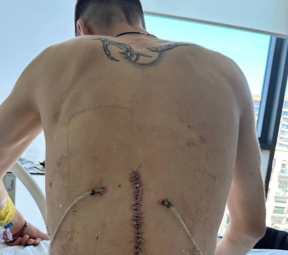 ctzn24's tweet photo. TOGETHER WITH OUR HEROES

🫡🇺🇦Vladyslav, call sign Bismark,
https://t.co/tmWQbF3eBM, 

❗️urgently requires surgery due to a spinal injury causing constant pain.

In 2021, he signed a contract and joined the 93rd Brigade 'Kholodnyi Yar' alongside other heroes. He was stationed in the Sumy and Kharkiv regions, where fierce battles took place after 24 February 2022. 

❗️❗️In June 2022, he sustained a severe spinal cord injury, requiring 23 surgeries... 
Although he is already using a wheelchair, there has been some improvement, but he still struggles with excruciating pain.

 ❗️❗️❗️The only hope of overcoming this pain is the installation of an electrical stimulator system, which will fortunately be provided free of charge through surgery. 

We have made a prepayment for a device that needs to be implanted, but we are unable to cover the remaining half of the cost, which amounts to 370,000 UAH. 
We are therefore looking for help.

AMOUNT TO BE RAISED: UAH 370,000

To help visit 
https://t.co/XnkM1EXMLF

MONOBANK jar https://t.co/d8dNMNkhIB

PRIVATBANK Card No. 4246 0010 0328 0330
IBAN PRIVATBANK https://t.co/yyRMHHHA5V 

Thank you … our defenders need your help...
@MelaniePodolyak @uavictory22 @kvistp
@GoldenR_Fella @GlasnostGone @SIKORA_slava
@JeannetteBaron @KasiaActus @uavictory22
@annasummer @ne_vluchiv @g900ap
@LesleyBeau60 @TridentUA @OlgaDiem
@trinzu @nafoprospect