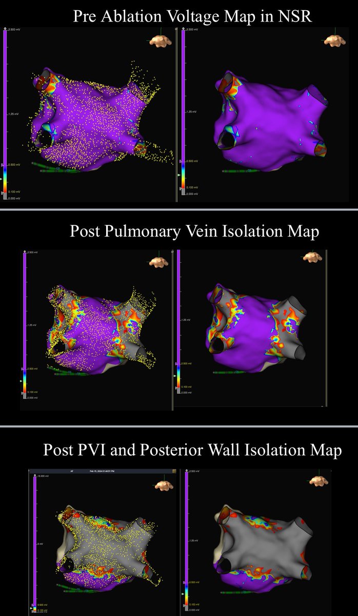 Fun day for us in Phoenix with pulsed field ablation. Love working with @su_wilber. 🙏@BannerHealth x @BSCCardiology