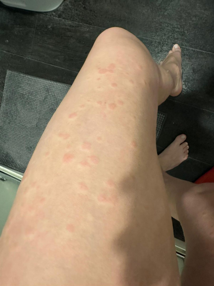 My nice is having flare ups on her legs and back. Her face and chest gets red/hot/blotchy too. She feels very run down, mouth ulcers and breaking nails. What does everyone think? I see so much of my MCAS symptoms but I'm only coming from my perspective. She's very stressed.