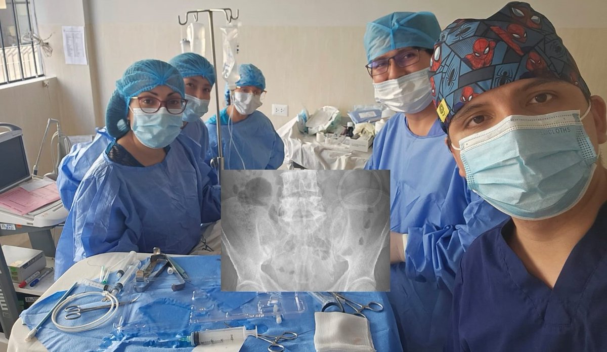 lluncornefro's tweet image. 📌Implante de Cateter Peritoneal ecoguiado tipo seldinger para inicio de TRR por nuestros residentes.
Serv Nefrologia - @H2deMayo 🇵🇪
Por ➕️ Diálisis Peritoneal
#PDFirst #InterventionalNephrology
#YoSoySLANHJoven