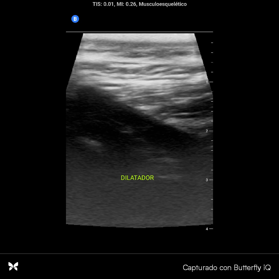 lluncornefro's tweet image. 📌Implante de Cateter Peritoneal ecoguiado tipo seldinger para inicio de TRR por nuestros residentes.
Serv Nefrologia - @H2deMayo 🇵🇪
Por ➕️ Diálisis Peritoneal
#PDFirst #InterventionalNephrology
#YoSoySLANHJoven