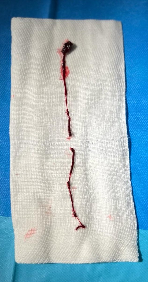 carmengonde's tweet photo. Usefulness of ICE in early detection of thrombus to avoid major complications. Fortunately we could see it just in time and extract it without problems! #EPeeps #0Fluoro #ICE @mduranguerrero @BiosenseWebster https://t.co/Vt60EdYF6l