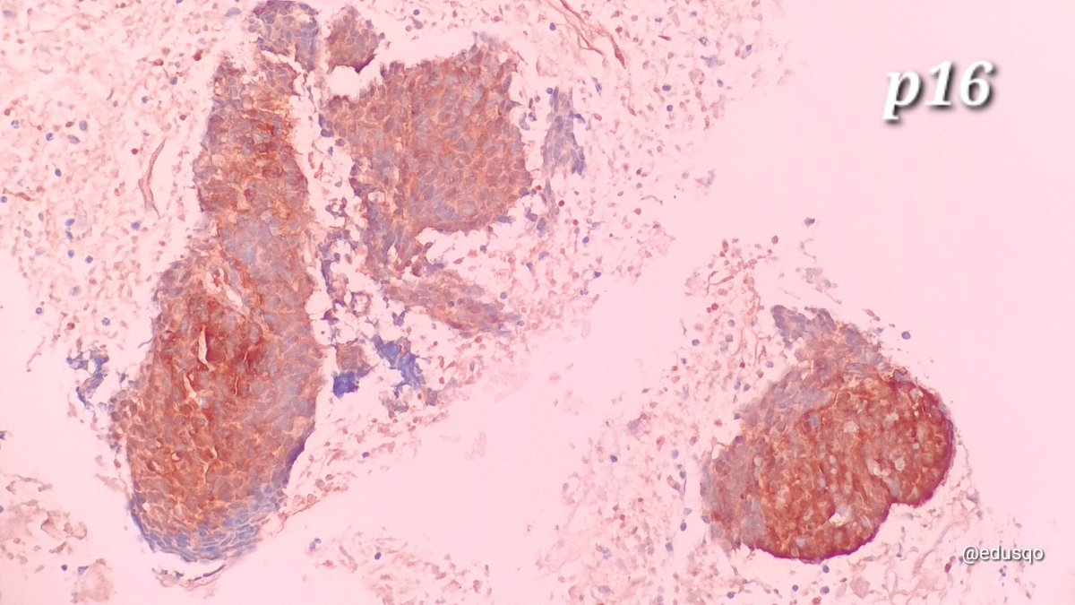 FNA of a metastatic HPV-related oropharingeal scc to cervical lymph node (primmary unknown 👀):
▫️Necrotic/cystic background (DDx tcb in HIV+ patients)
▫️Cohesive groups of hyperchromatic cells
▫️No keratinization in this case
▫️#IHCPath p16+/EBER-
#CytoPath #FNAFriday #ENTPath