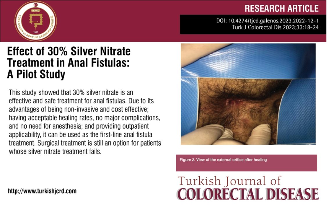 Effect of 30% Silver Nitrate Treatment in Anal Fistulas: A Pilot Study

You can see the free full text of the research by Wafi Attaallah et al.

Link : cms.turkishjcrd.com/Uploads/Articl…

#Anal #fistula #proctology #silver #nitrate
