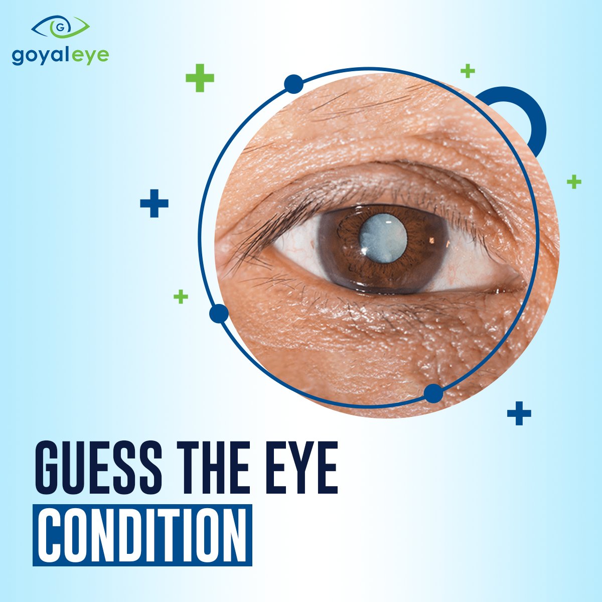 goyaleye's tweet image. Guess the eye condition!

A serious eye problem characterized by increased intraocular pressure, potentially leading to optic nerve damage &amp;amp; vision loss

#GoyalEye #EyeCondition #EyeProblem #Glaucoma #EyeHealth