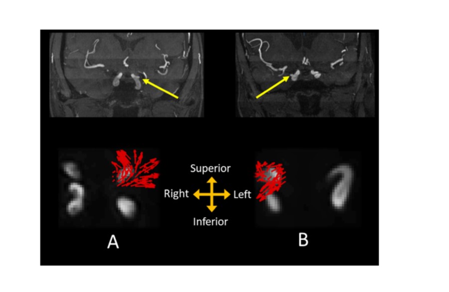 Aneurysm wall motion as a marker of growth and instability? Amplified flow (aFlow) image processing tracks aneurysm wall motion via cine and 4D Flow MRI and shows increased wall motion and deformation in growing vs. stable aneurysms bit.ly/3STacw7 @APionteck @KambizNael