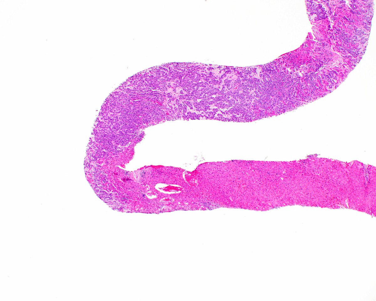 LizMontgomeryMD's tweet photo. Once in a while gastrointestinal stromal tumors aberrantly express keratin. This one has metastasized to the liver. Yet another pitfall to consider! #UMiamiPath https://t.co/qbnuhJxcLC