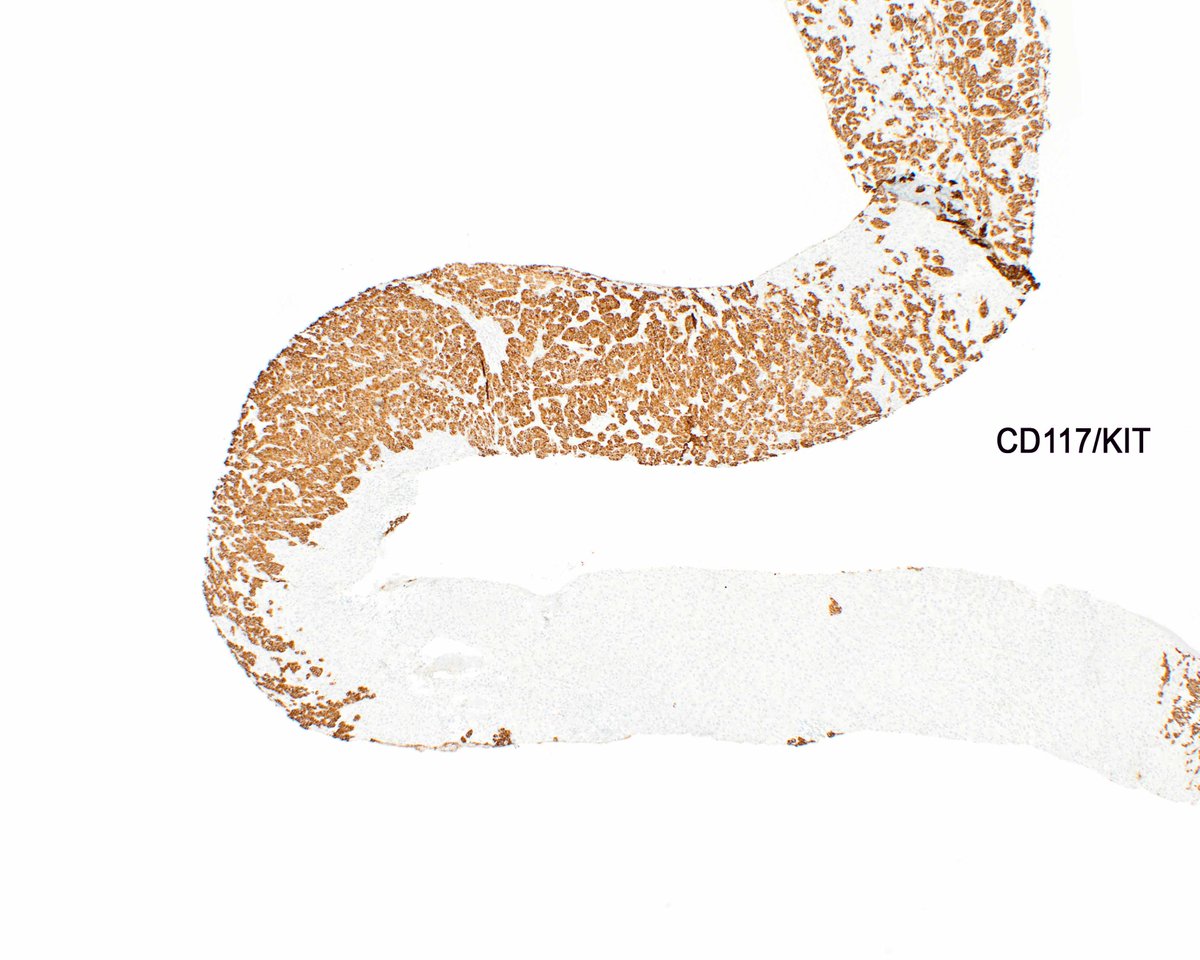 LizMontgomeryMD's tweet photo. Once in a while gastrointestinal stromal tumors aberrantly express keratin. This one has metastasized to the liver. Yet another pitfall to consider! #UMiamiPath https://t.co/qbnuhJxcLC