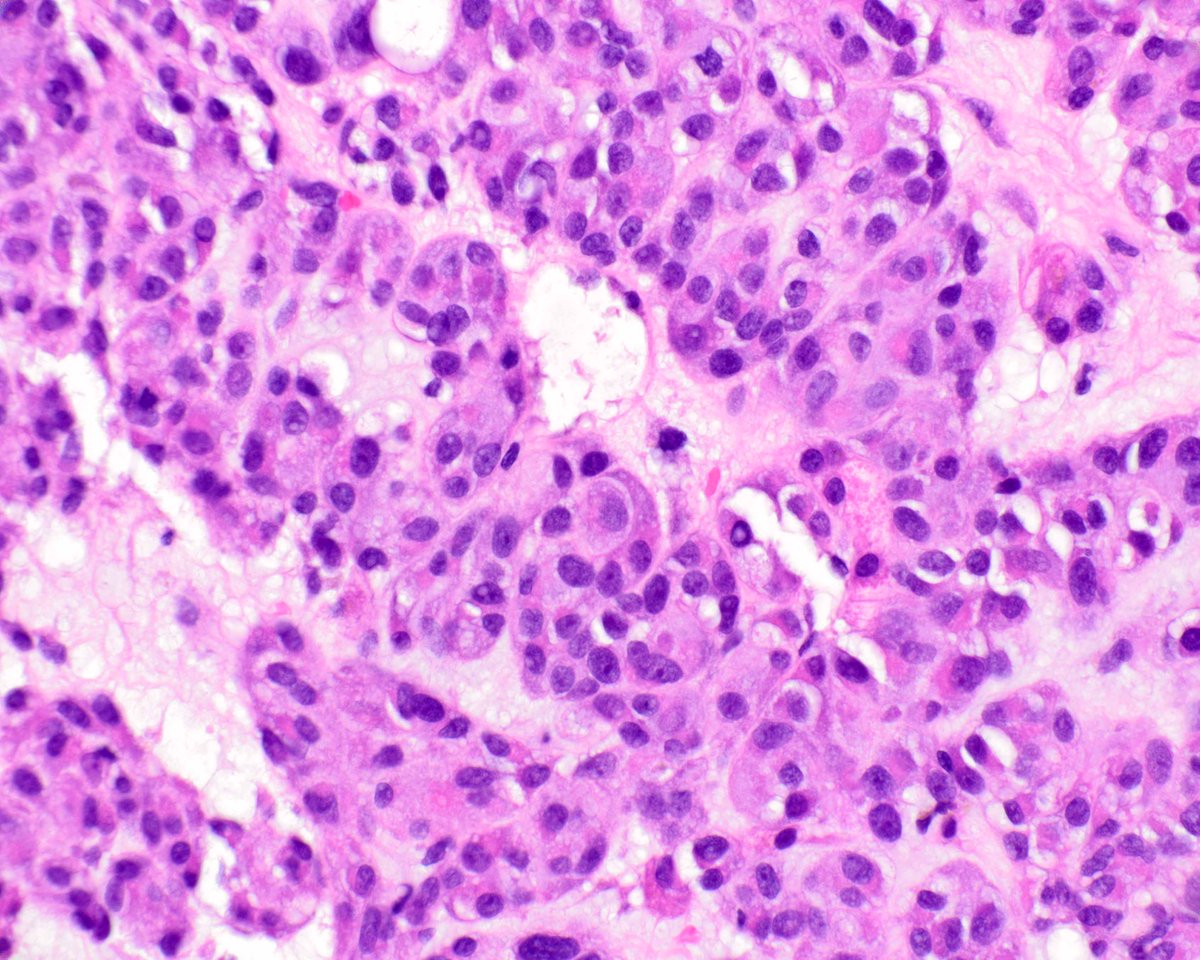 LizMontgomeryMD's tweet photo. Once in a while gastrointestinal stromal tumors aberrantly express keratin. This one has metastasized to the liver. Yet another pitfall to consider! #UMiamiPath https://t.co/qbnuhJxcLC