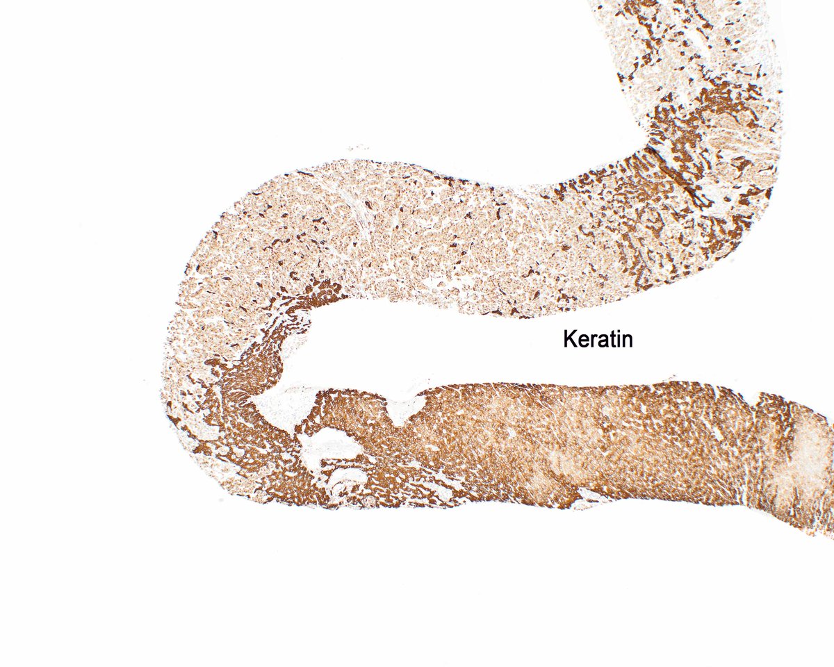 LizMontgomeryMD's tweet photo. Once in a while gastrointestinal stromal tumors aberrantly express keratin. This one has metastasized to the liver. Yet another pitfall to consider! #UMiamiPath https://t.co/qbnuhJxcLC