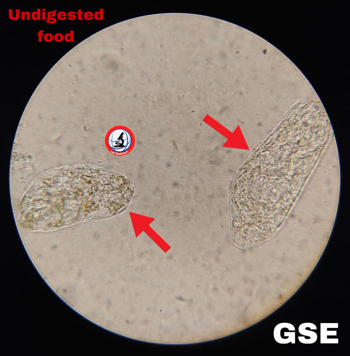 Lab_Medicine1's tweet image. #gse #GSE #undigested food youtube.com/@Lab_Medicine1