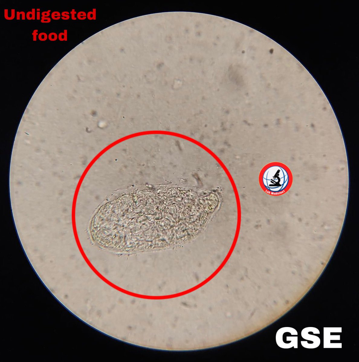 Lab_Medicine1's tweet image. #gse #GSE #undigested food youtube.com/@Lab_Medicine1