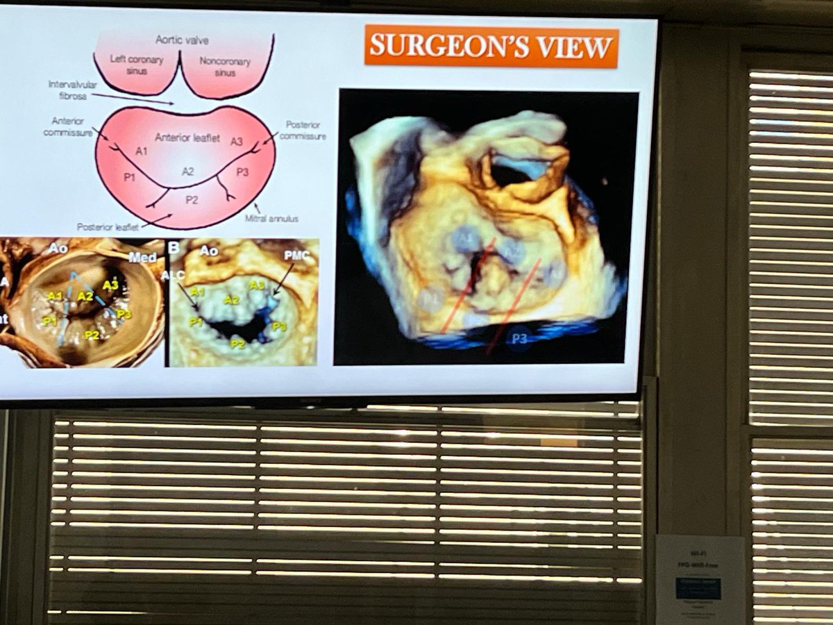 Afternoon session led by @fiore_corrado ✅ valves anatomy ✅ prosthesis ✅ loads of hands on session! 💫💫💫 Great job and good vibes 💫💫💫 #EchoMasterRome @GabriellaLocor1 @Anto_Lombard