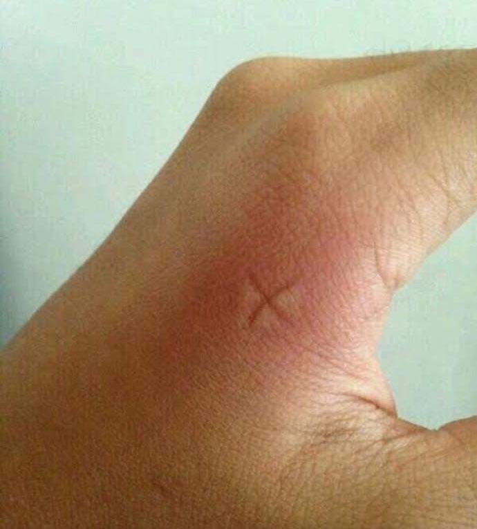 Necesito que alguien me explique el mecanismo fisiopatológico por el cual cuando te haces la cruz de la muerte en una picadura de mosquito, automáticamente te deja de picar