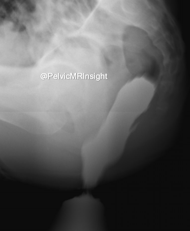 maabdelatty's tweet photo. 🙋🏻‍♂️ NEW CASE ALERT 🙋🏻‍♂️
35-year-old male complaining of back pain and obstructed defecation symptoms referred for conventional defecography. What is the pertinent abnormality on these images? 
#defecography #Pelvicfloor #Radiology #Xray #barium #proctography https://t.co/RhebZ1Xs9L
