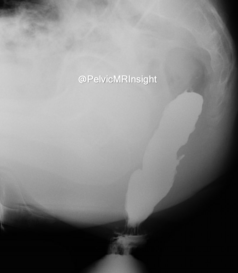 🙋🏻‍♂️ NEW CASE ALERT 🙋🏻‍♂️
35-year-old male complaining of back pain and obstructed defecation symptoms referred for conventional defecography. What is the pertinent abnormality on these images? 
#defecography #Pelvicfloor #Radiology #Xray #barium #proctography