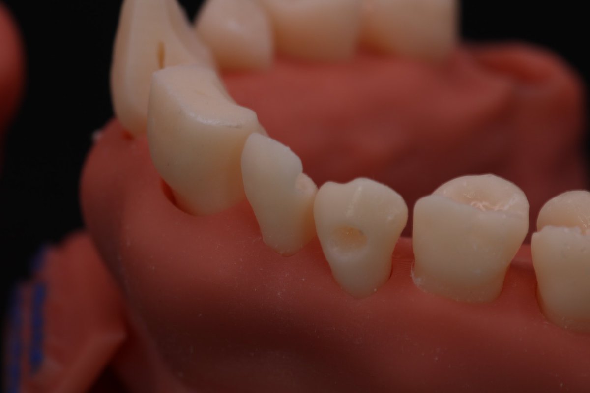 OdontoHamad's tweet photo. جانا طلب خاصة ، خصخص فيه الفك علوي و سفلي و اختار Mixed Dentition with combination of Ellis and G.V Black classification 
و حبينا نطلع عن الروتين و سوينا اختبار بسيط لطيف نسئل فيها صاحب الطلب عن عمر المريض الي صمم هو نوع التدريب بناء على الاسنان الي اختارها في الفك 🤣🫡 https://t.co/93AKbyAVGO