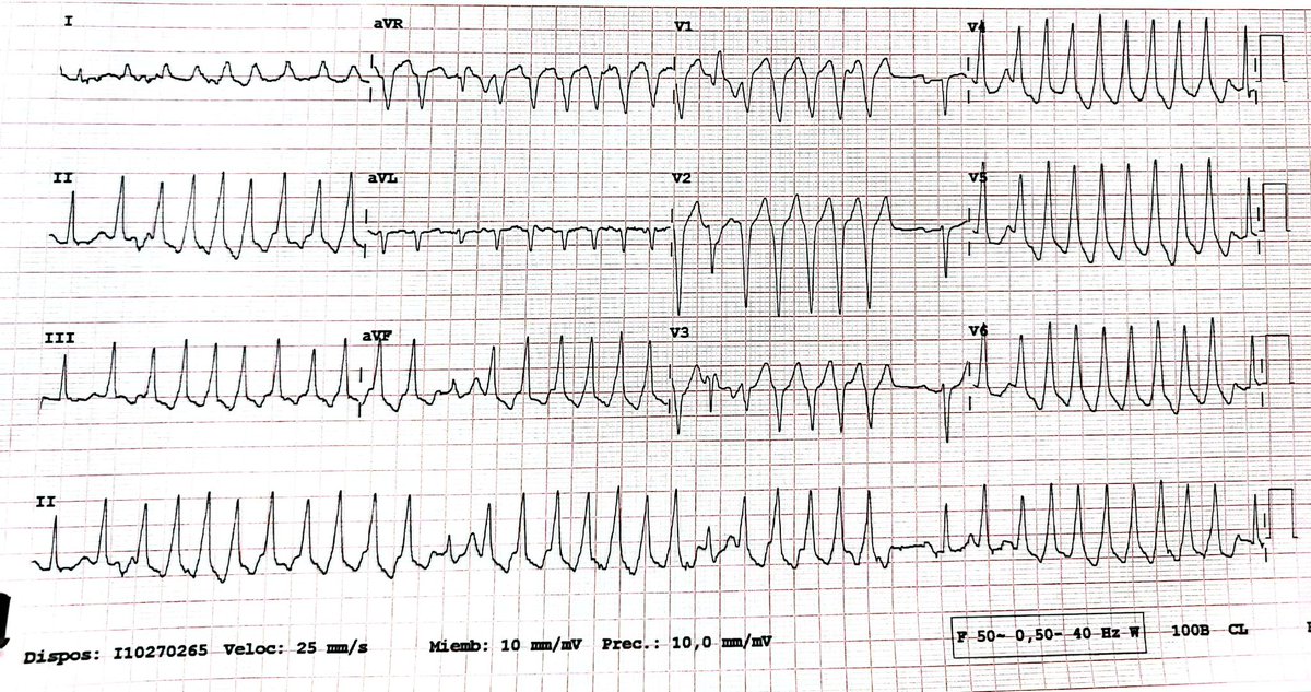 ECG💡 INTERESANTE: 🥸 69 años que acude al 🏥 por síncope 🙃 🤔 Qué te parece este trazado?