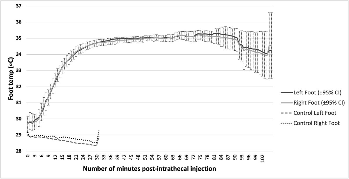 Observational study of peripheral skin temperature changes following spinal anaesthesia for caesarean
🌡️⬆️ skin temperature of both feet 
🌡️Max. rate of increase between 6-15 mins after the spinal
🌡️No change in control group
#FOAMed #OpenAccess #ObAnes
obstetanesthesia.com/article/S0959-…