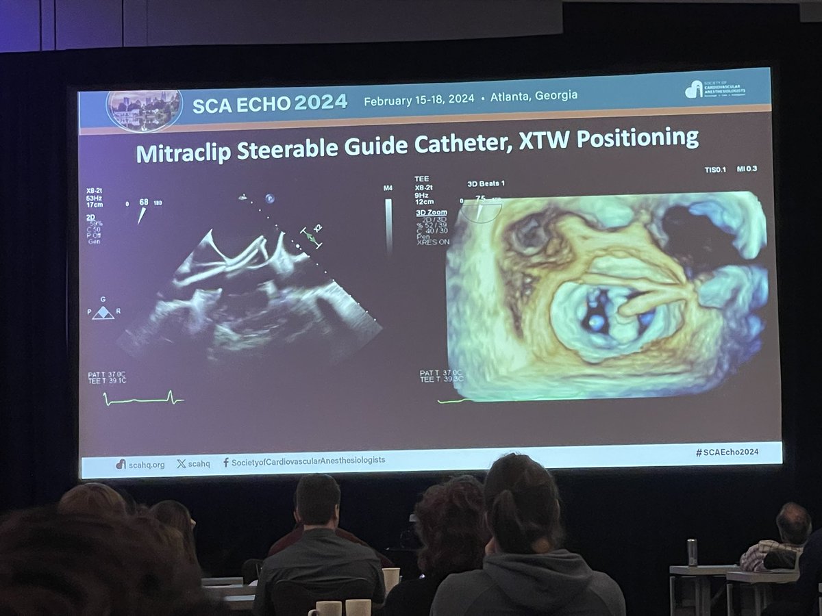 #SCAEcho2024 Excellent discussion on Nuts and Bolts for A2/P2 TEER in Structural Heart Disease I.@kibelani highlights precision and accuracy in structural heart imaging. #SCAEcho2024 @WomenInCTAnes @MondalSamhati @charles_nyman @RichardSheuMD