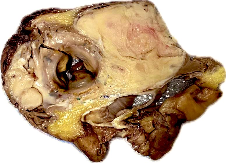 30-year-old man (no medical history) with a large fleshy whitish mass with infiltrating edges. It is in the ventricular septum and extends to the mitral annulus and pericacardial fat. protrudes into the ventricular cavity. #path #cardiopath #softtissue