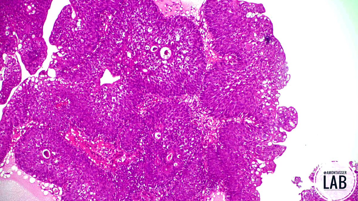 M, 25 Y ⚠️

Urinary bladder; TURBT 
👉🏽Two opinions 

☝🏽Papilloma: 
• Age 
• Simple papillae 
• Umbrella cells are preserved

✌🏽PUNLMP:
• Endophytic (inverted) component present.
• Layers are focally thicker than normal urothelium 

What do you think 🤔 
#GUpath #PathTwitter