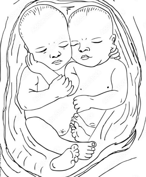 ♊️Finland study: Twin deliveries ♊️ For second twin, epidural analgesia associated with: 🪢Lower rate of emergency CS 🪢Lower neonatal mortality 🪢Higher rate of assisted vaginal delivery #OpenAccess #FOAMed #twins Full paper: obstetanesthesia.com/article/S0959-…