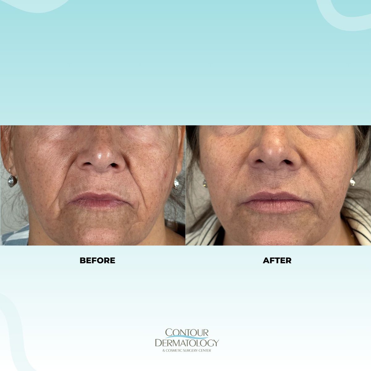 It's amazing what fillers can do to freshen up your look. Thinking about giving it a try?V Contact us today! ➡️ buff.ly/3uCXZ56