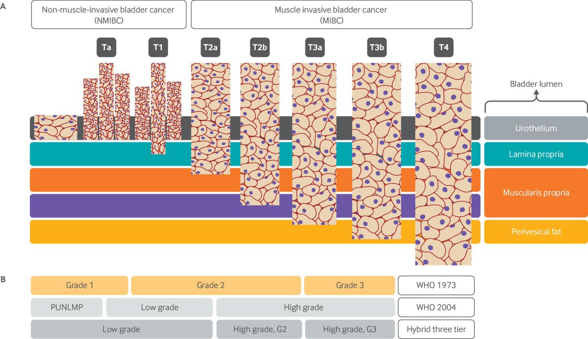 NEWEST State-of-the Art -Review on #BladderCancer  just released this week  @BMJ_latest (BMJ Journal impact factor 107!)
I am exceedingly honored to be invited to work on this commissioned review with Drs. Lopez-Beltran, Cookson, Guercio
Check it out - 
bmj.com/content/384/bm…
