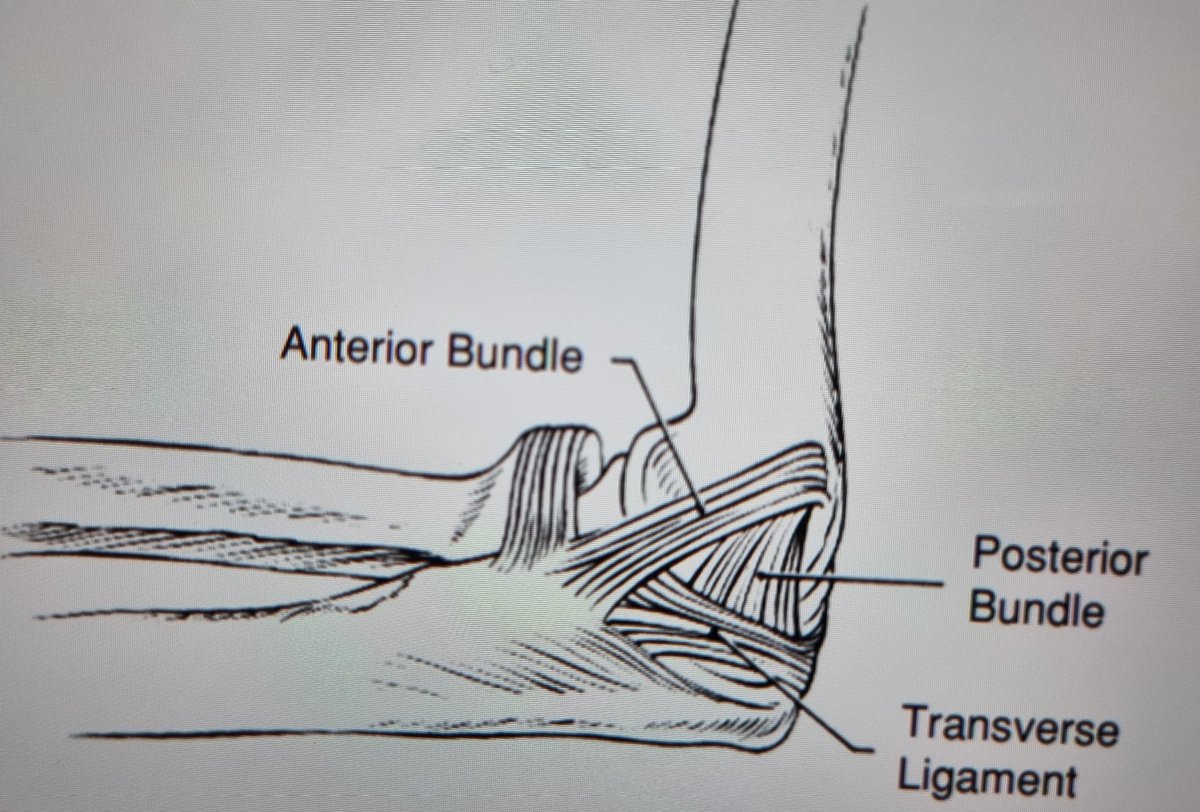 DrSanchezAlepuz's tweet photo. ⚽️ Caída con el brazo en hiperextesion y valgo forzado.
🏈 Luxacion codo con reducción espontánea 
🏉 Exploración bajo anestesia general: inestabilidad aguda severa
Sigue el HILO https://t.co/oeJxqfojb5