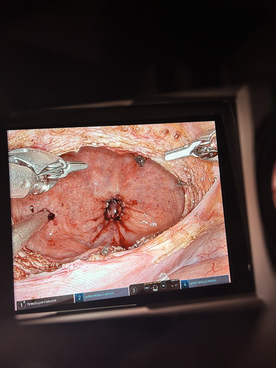 Lance Hampton (@lancehampton42) on Twitter photo I’m calling this the <a href="/md_eun/">Daniel D Eun MD</a> Eun pseudoanastamosis or EunMosis for short for robotic simple prostatectomy. What a game changer! I’m calling this the <a href="/md_eun/">Daniel D Eun MD</a> Eun pseudoanastamosis or EunMosis for short for robotic simple prostatectomy. What a game changer!